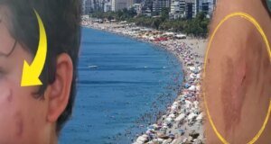 Vatandaşlar tedirgin! Denize giren yanıklarla çıkıyor