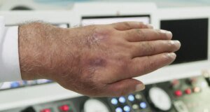 Doktorlar bile şaşırdı! Hırsız elini öyle bir ısırdı ki vaka literatüre girmeye hazırlanıyor